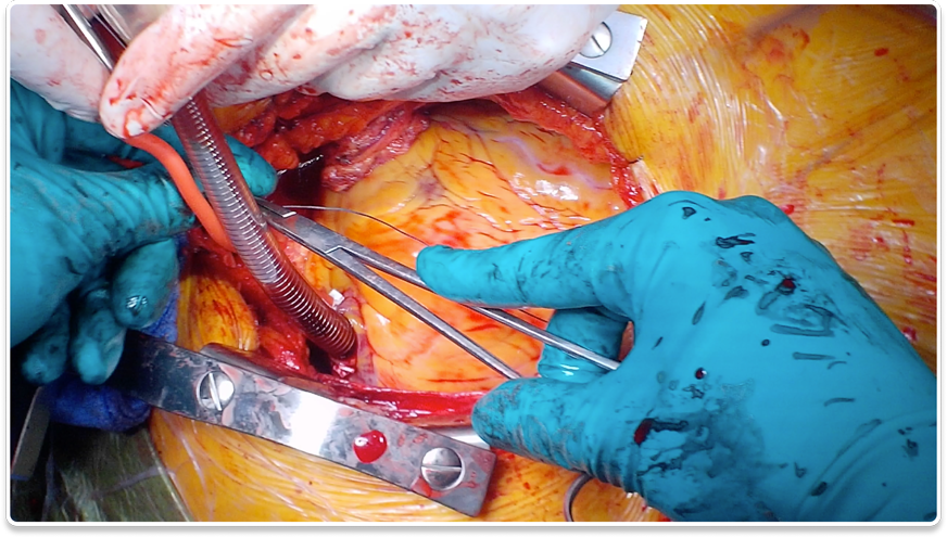 Edit videos of Surgery